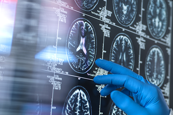 Doctores viendo la distribución de los receptores NMDA en el cerebro de un paciente con Alzheimer. 